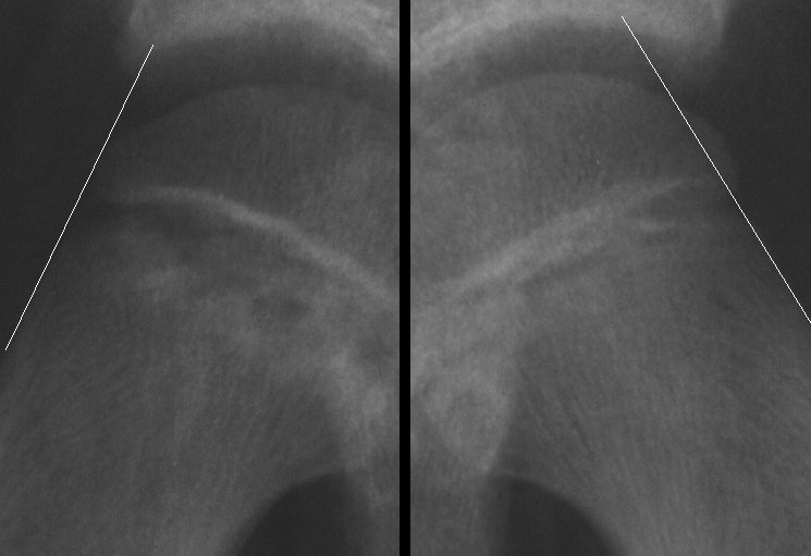 Slipped Capital Femoral Epiphysis (SCFE) Pediatrics Orthobullets